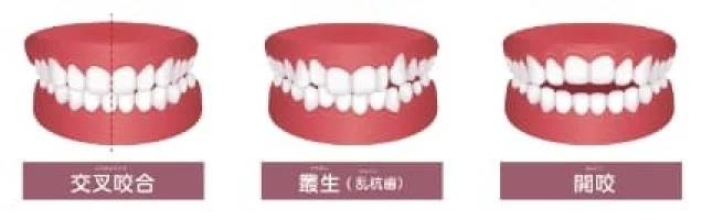 交叉咬合・叢生（乱杭歯）・開咬